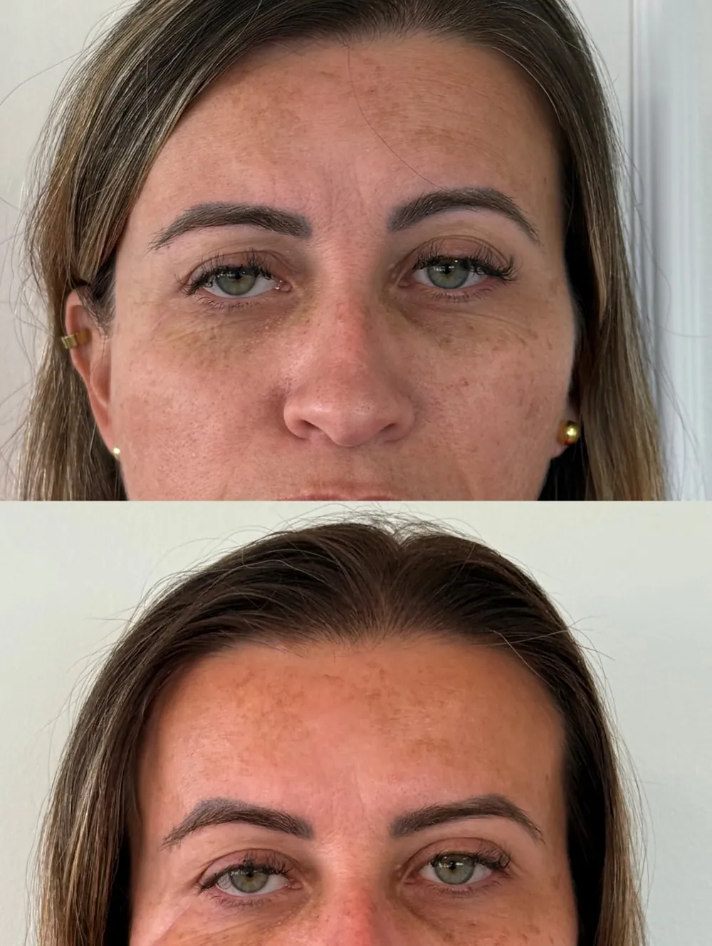 Caso 01: antes e depois, segundo ângulo do terço superior