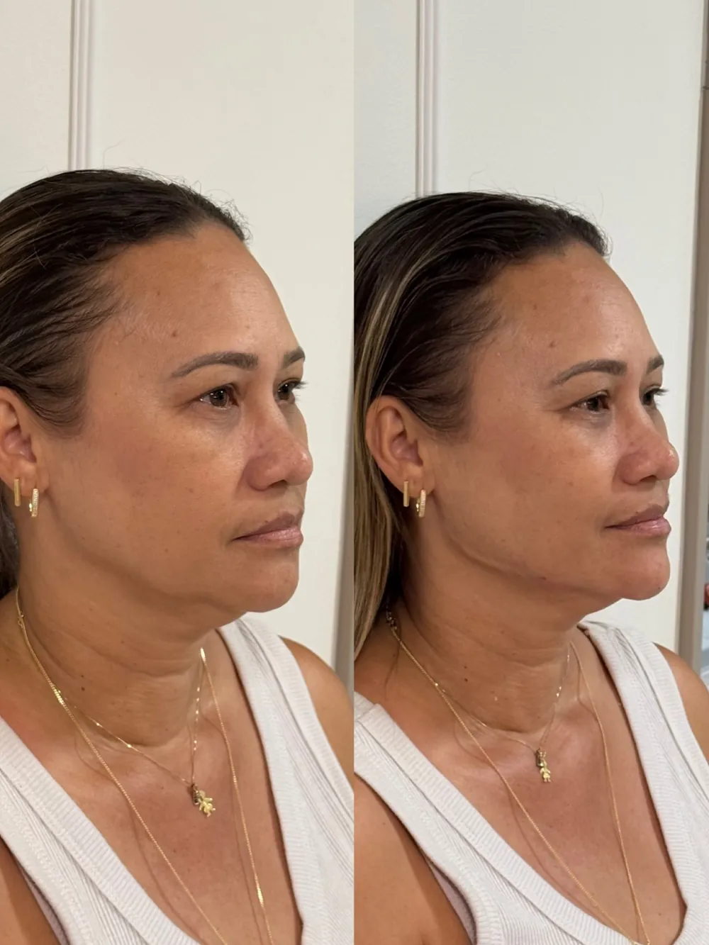 Caso 04: antes e depois, segundo ângulo