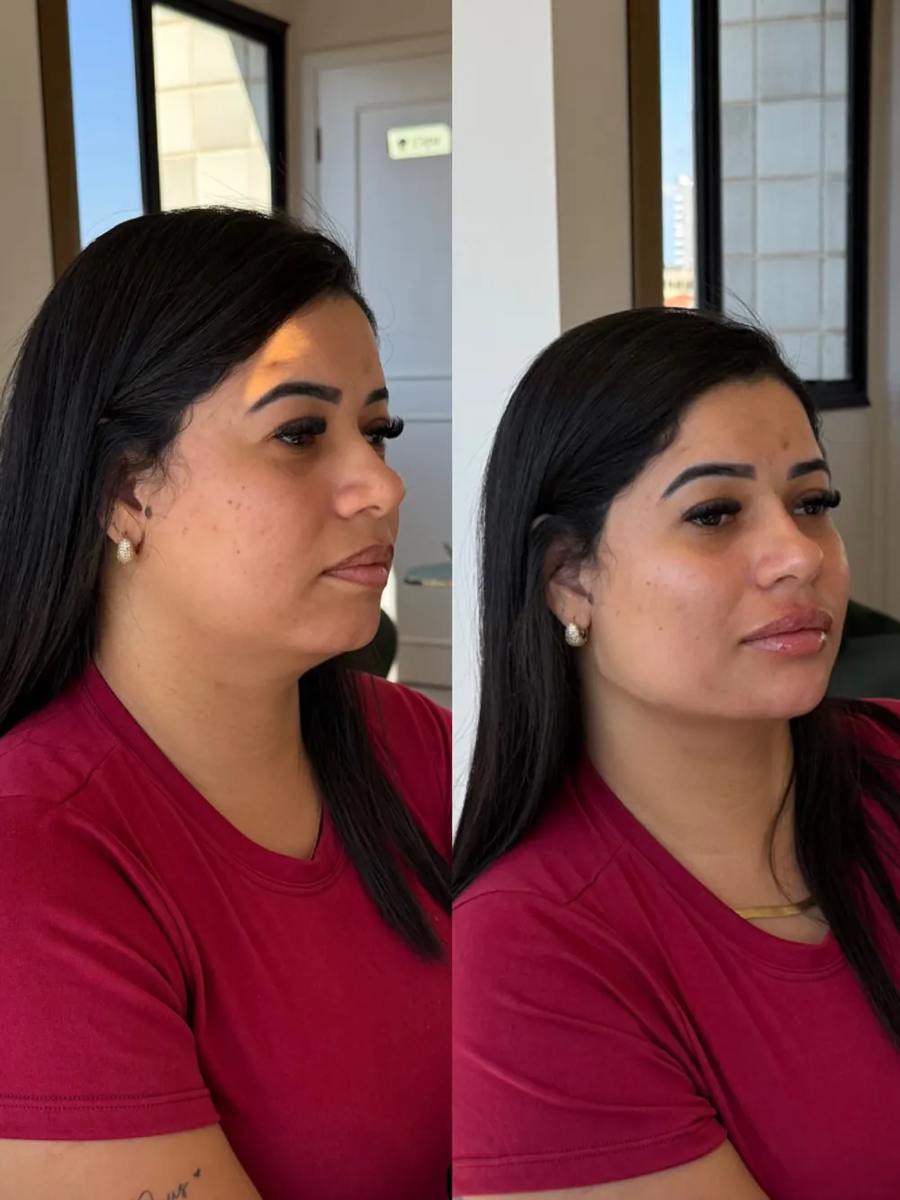 Caso 05: antes e depois de harmonização orofacial, perfil