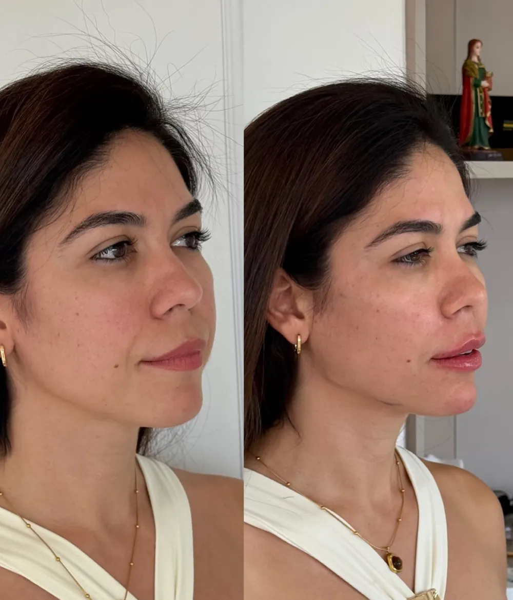 Caso 06: antes e depois, segundo ângulo