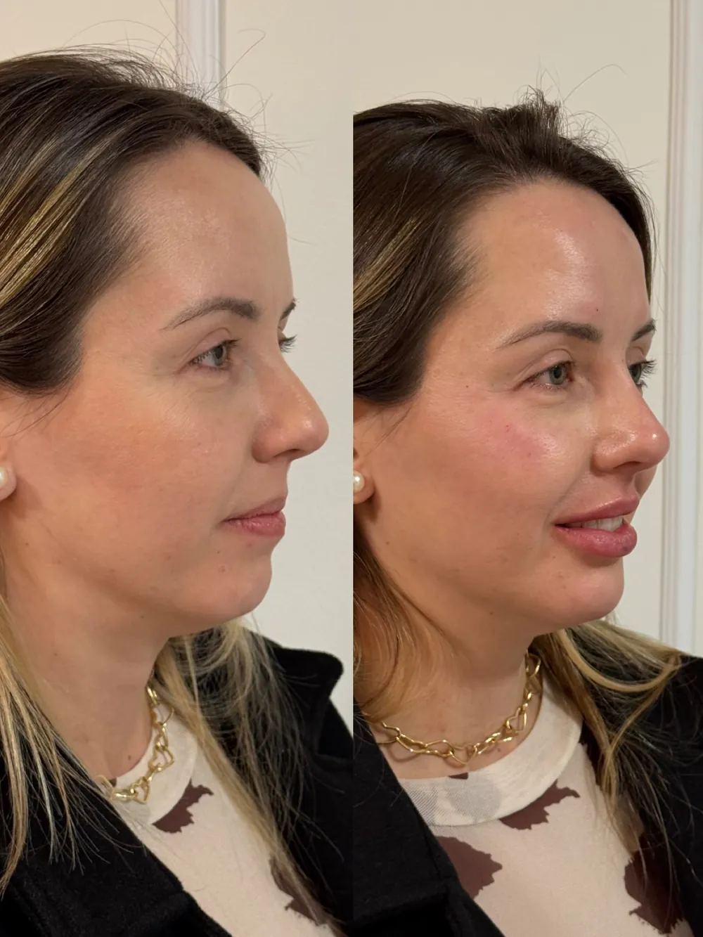 Caso 10: antes e depois, quarto ângulo