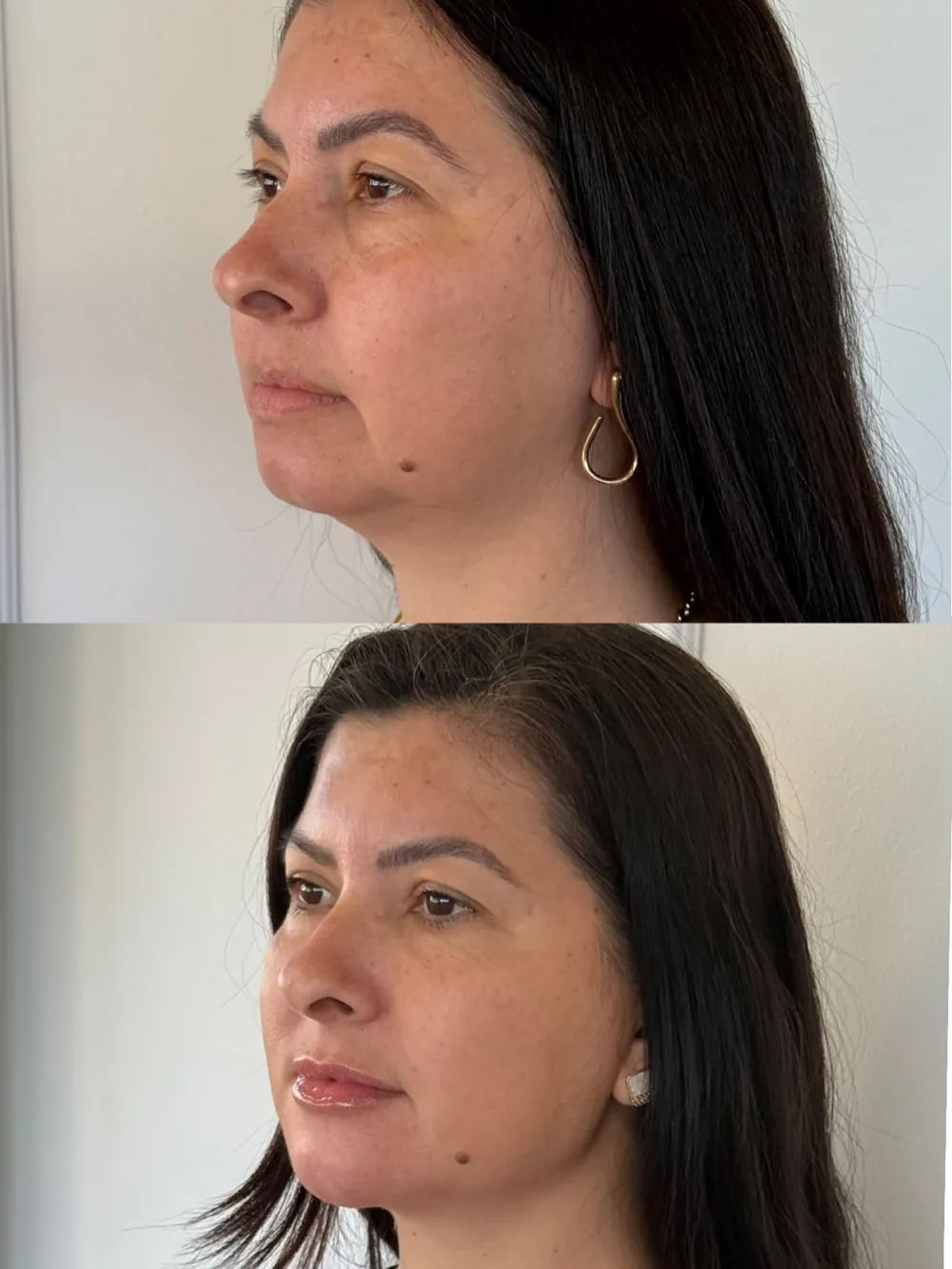 Caso 11: antes e depois, terceiro ângulo