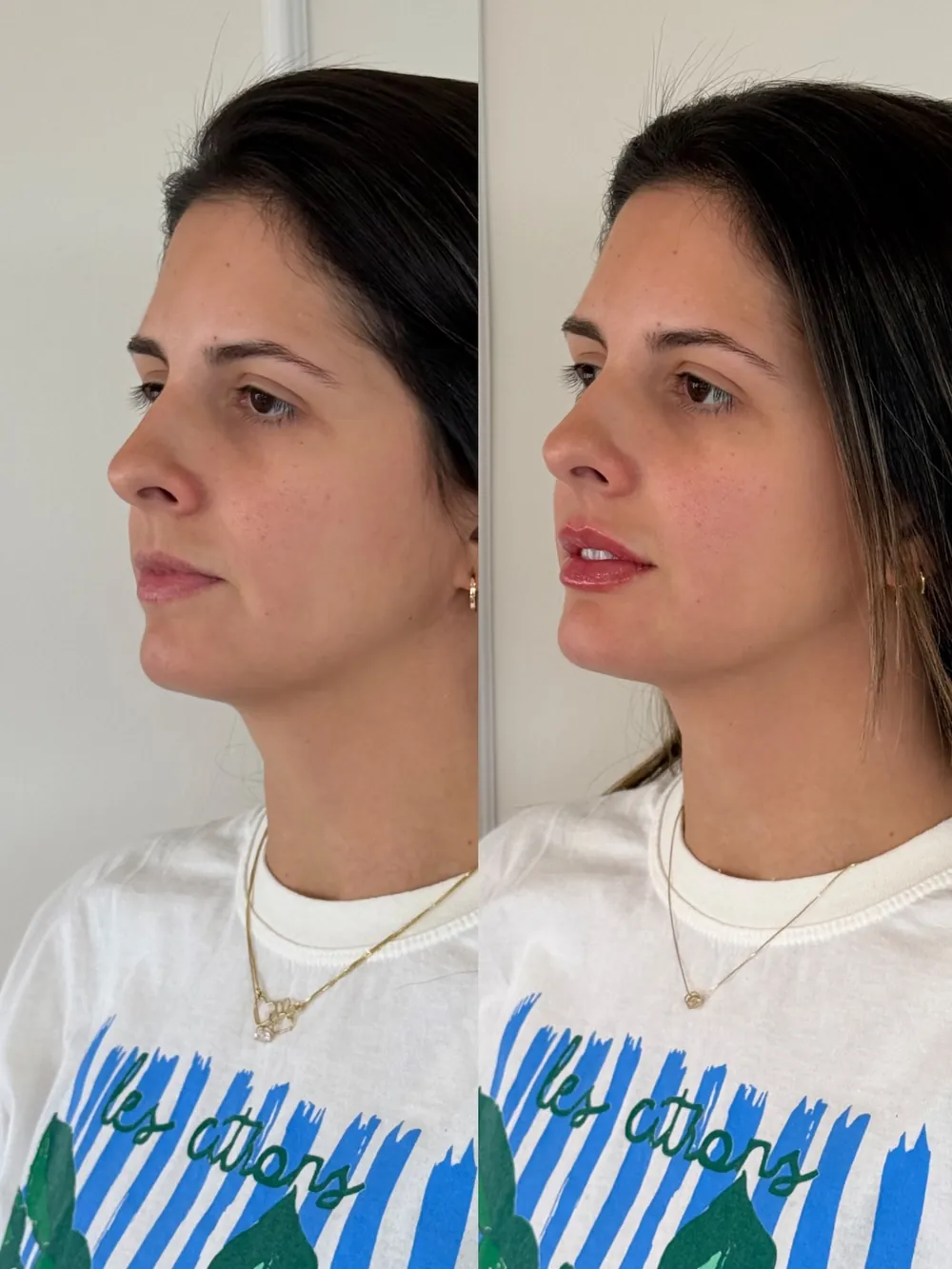 Caso 12: antes e depois, segundo ângulo